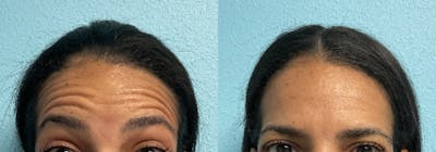 BOTOX & Dysport Before & After Gallery - Patient 387382 - Image 1