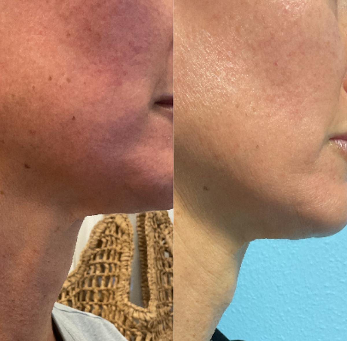 SkinPen Microneedling Before & After Gallery - Patient 517412 - Image 1