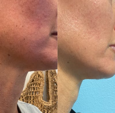 SkinPen Microneedling Before & After Gallery - Patient 517412 - Image 1