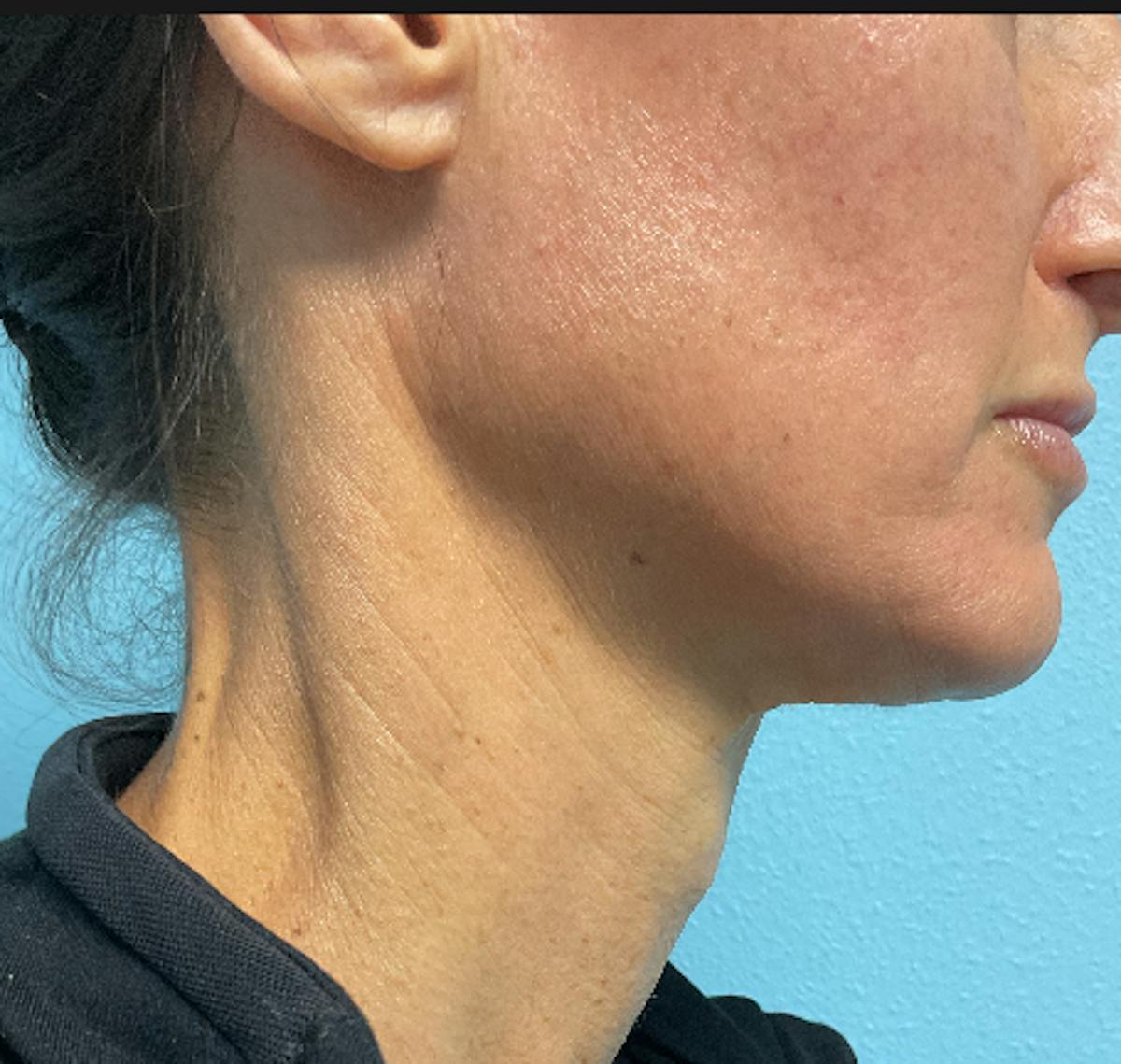SkinPen Microneedling Before & After Gallery - Patient 517412 - Image 3