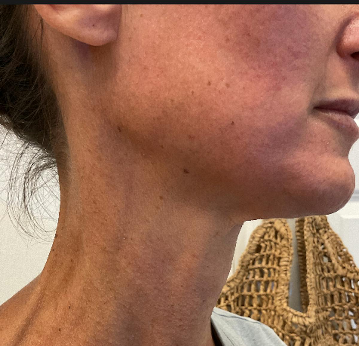 SkinPen Microneedling Before & After Gallery - Patient 517412 - Image 2