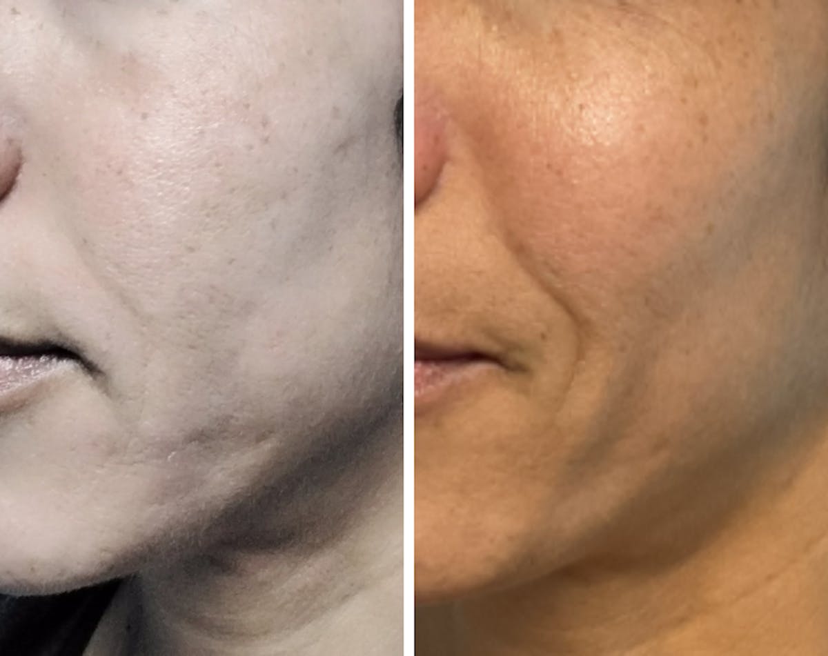 Lyft Before & After Gallery - Patient 888289 - Image 1