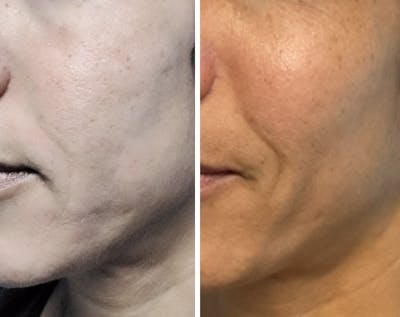 Lyft Before & After Gallery - Patient 888289 - Image 1