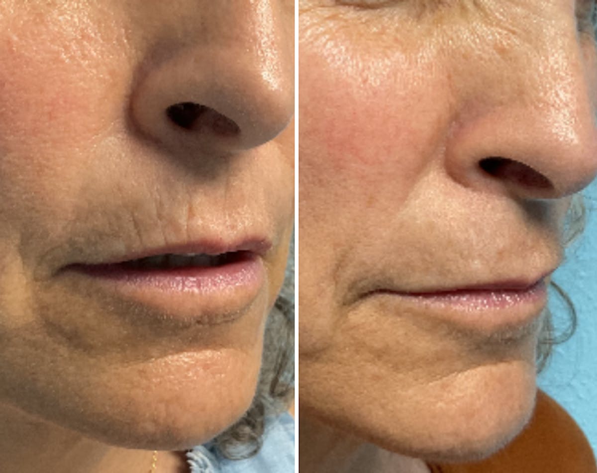 Dermal Fillers Before & After Gallery - Patient 299000 - Image 1