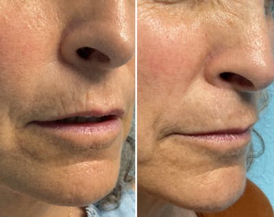Dermal Fillers Before & After Gallery - Patient 299000 - Image 1