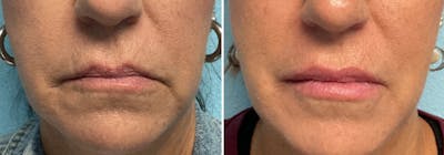 Dermal Fillers Before & After Gallery - Patient 397080 - Image 1