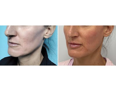 Cheeks & Lips Before & After Gallery - Patient 255044 - Image 1