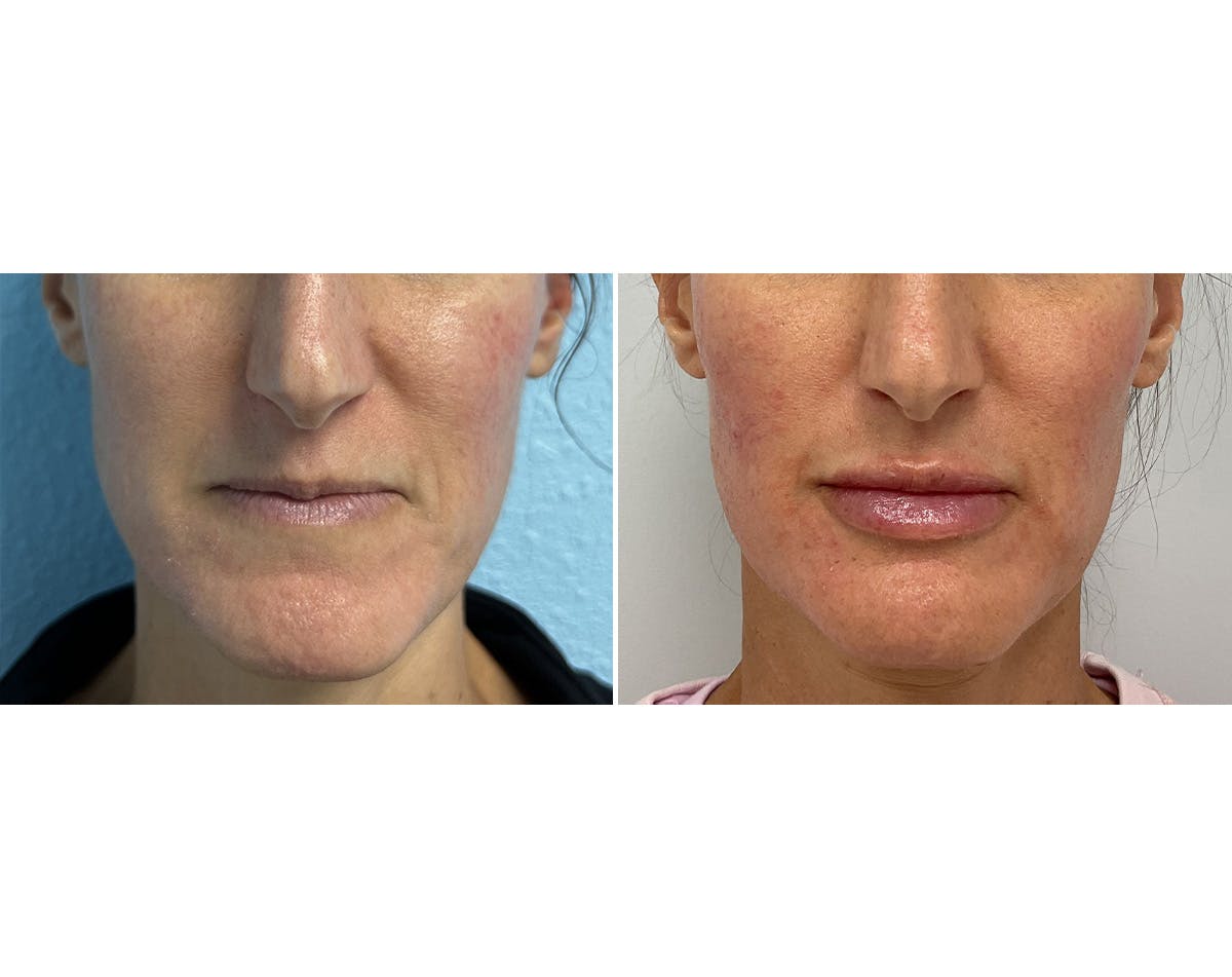 Cheeks & Lips Before & After Gallery - Patient 255044 - Image 2