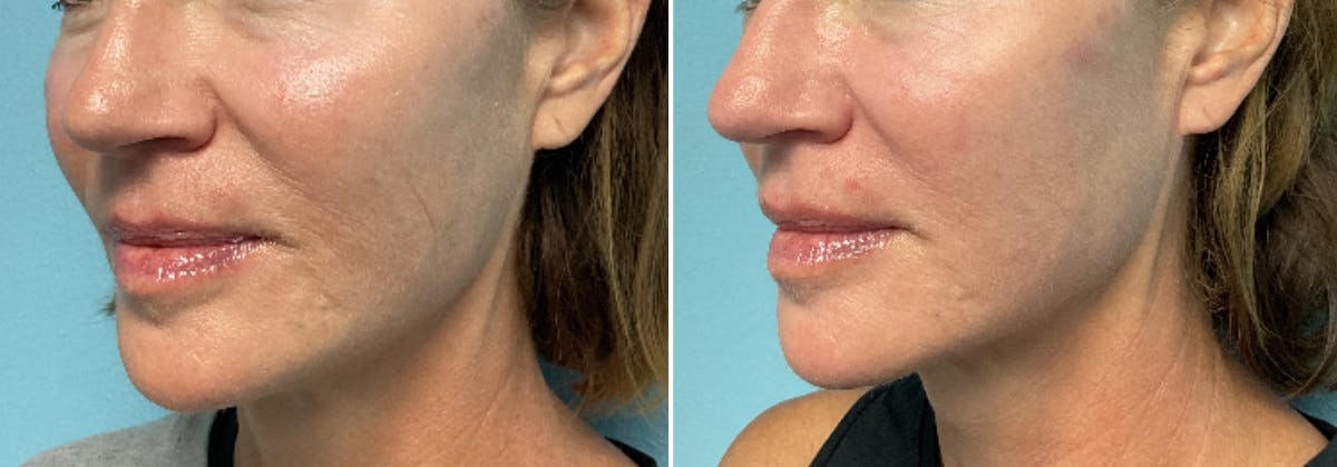 Moxi Laser Before & After Gallery - Patient 249445 - Image 1