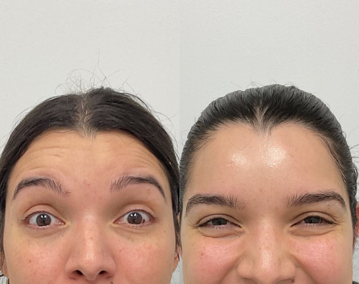 BOTOX & Dysport Before & After Gallery - Patient 406420 - Image 1