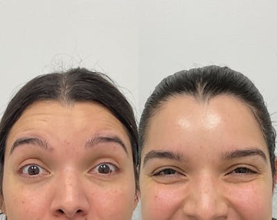 BOTOX & Dysport Before & After Gallery - Patient 406420 - Image 1
