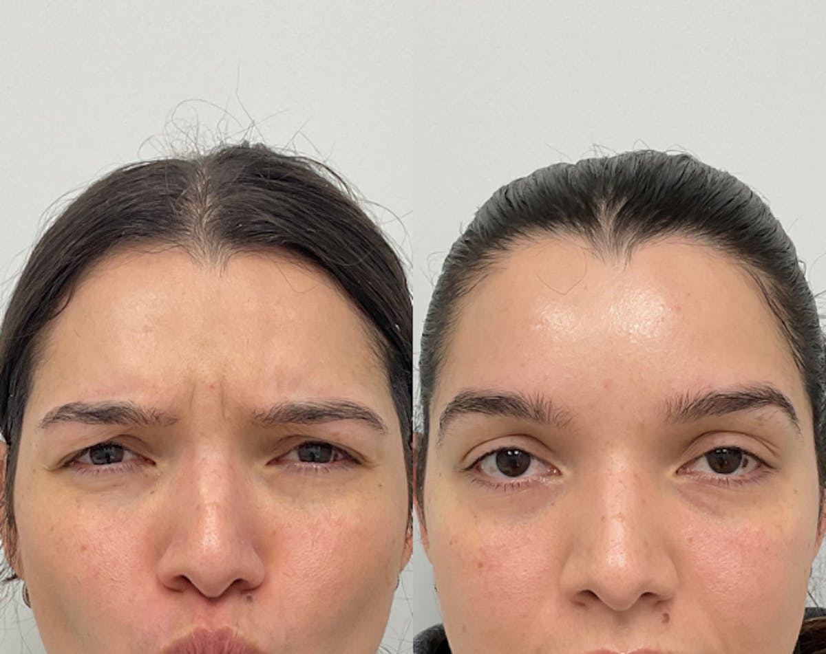 BOTOX & Dysport Before & After Gallery - Patient 406420 - Image 2
