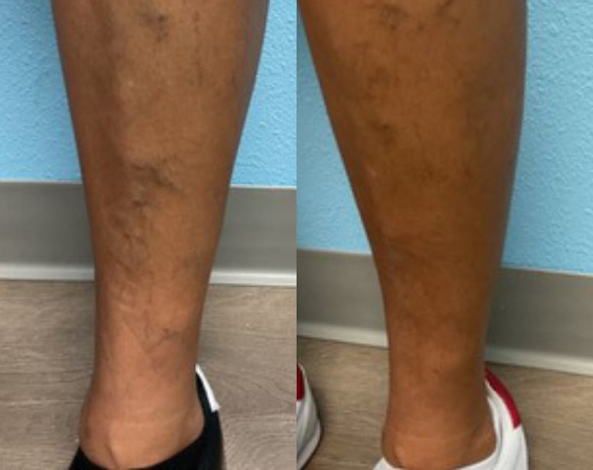 Sclerotherapy Before & After Gallery - Patient 291842 - Image 1