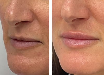 Kysse Before & After Gallery - Patient 538833 - Image 1