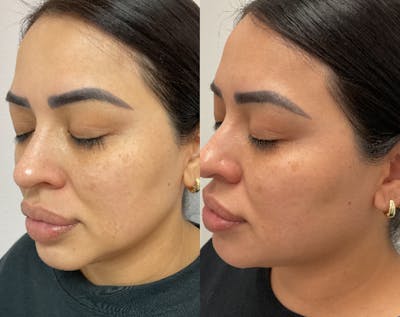 VI Peel Before & After Gallery - Patient 557712 - Image 1