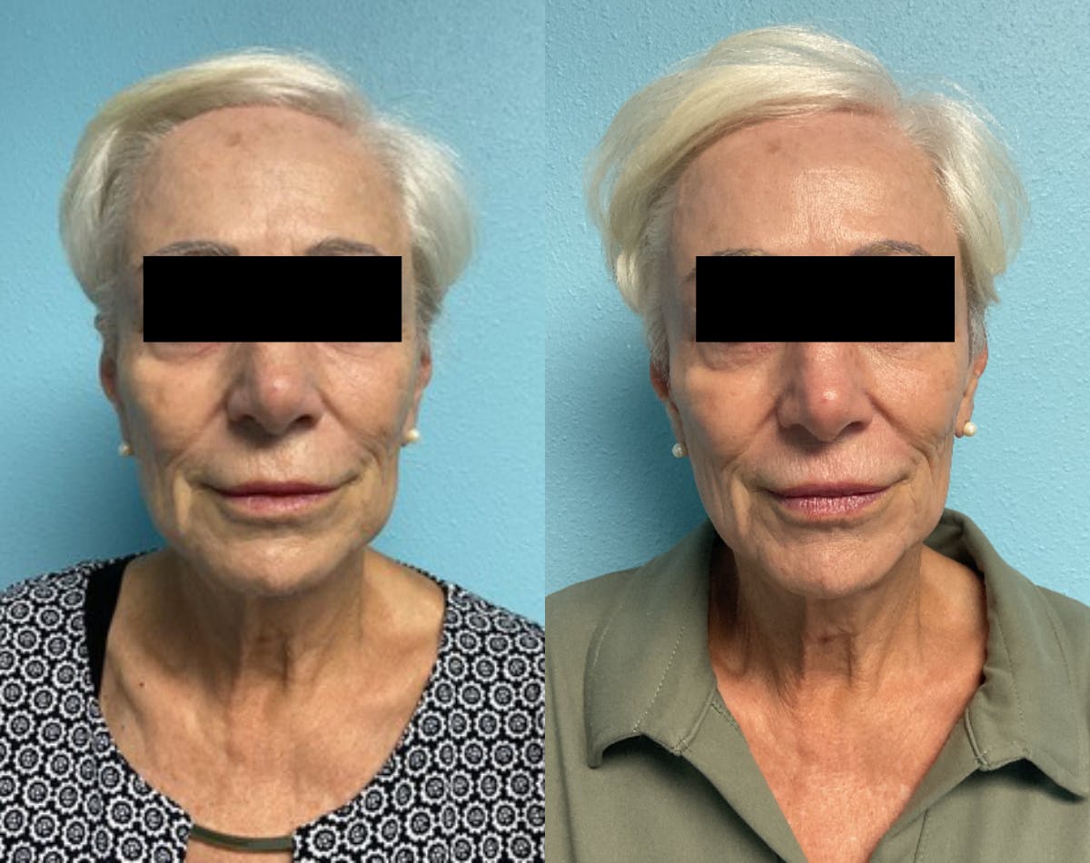 Moxi Laser Before & After Gallery - Patient 265234 - Image 1