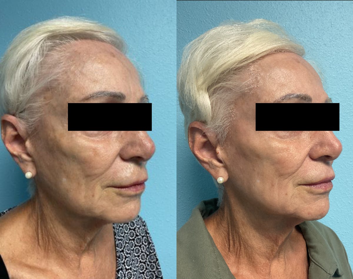 Moxi Laser Before & After Gallery - Patient 265234 - Image 2