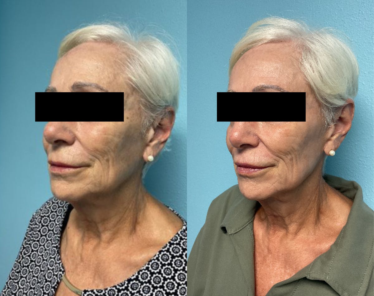 Moxi Laser Before & After Gallery - Patient 265234 - Image 3