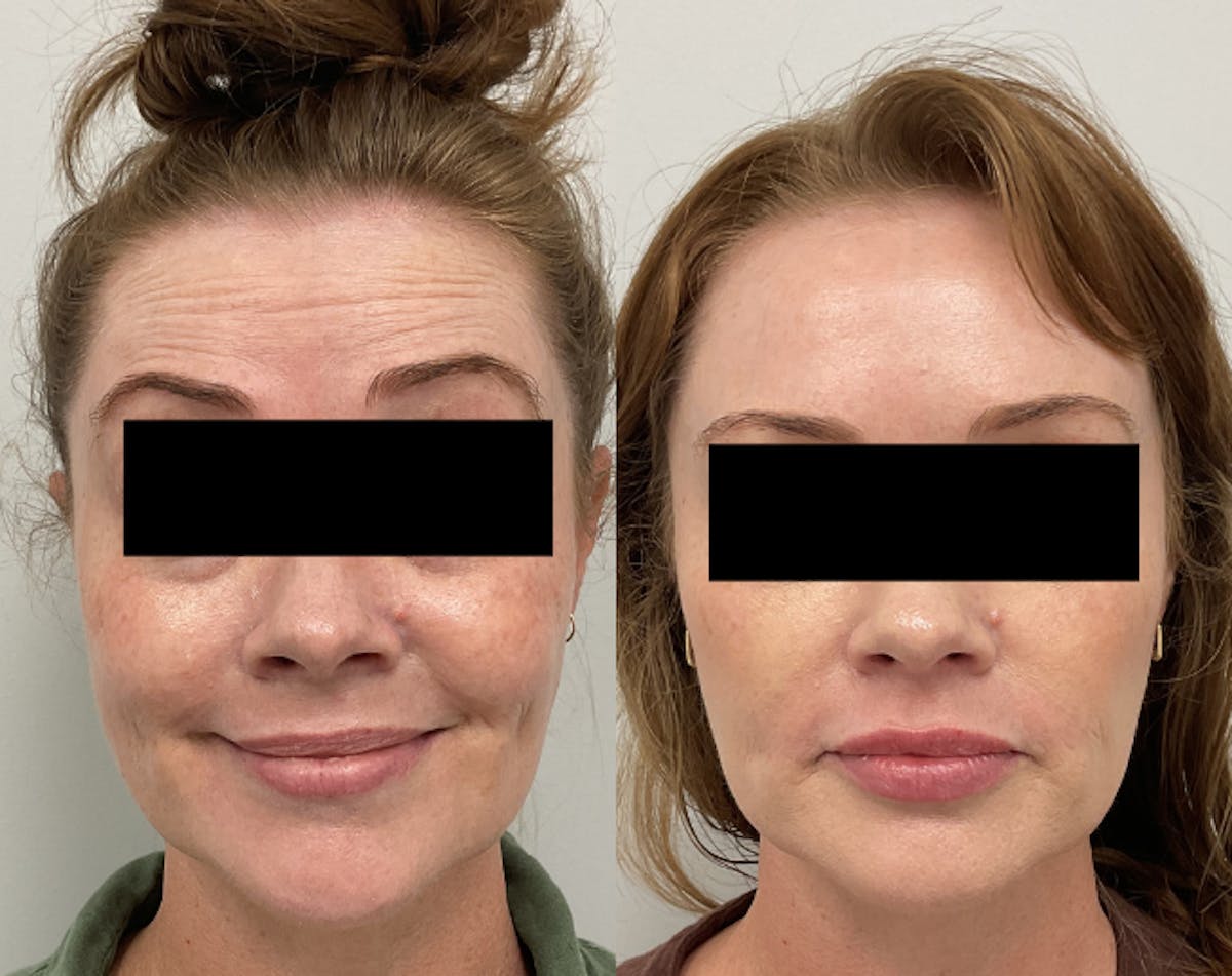 BOTOX & Dysport Before & After Gallery - Patient 347590 - Image 1