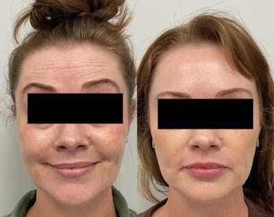 BOTOX & Dysport Before & After Gallery - Patient 347590 - Image 1