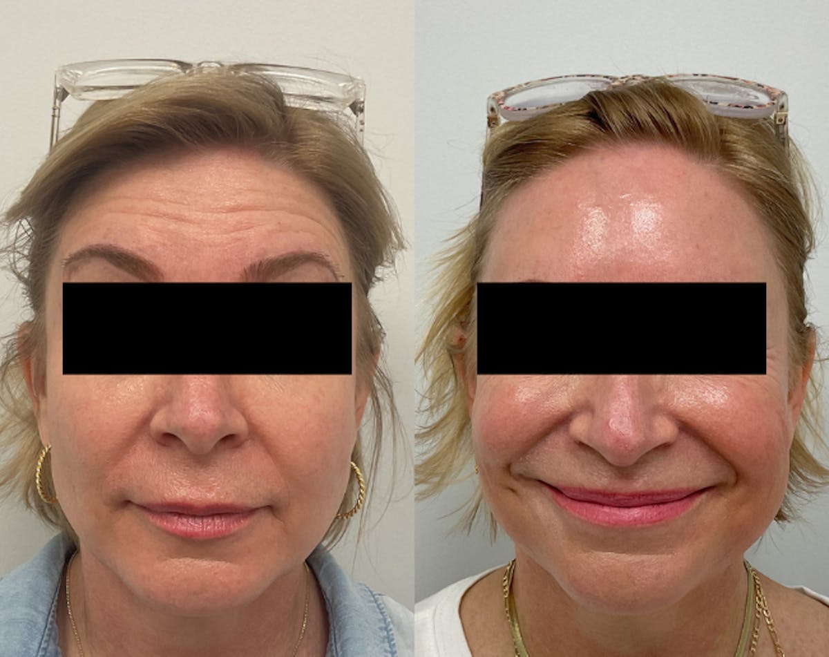 BOTOX & Dysport Before & After Gallery - Patient 289084 - Image 1