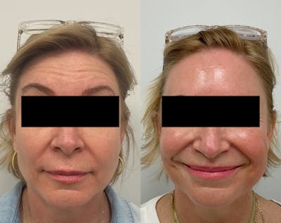 BOTOX & Dysport Before & After Gallery - Patient 289084 - Image 1
