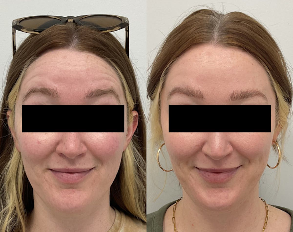 BOTOX & Dysport Before & After Gallery - Patient 356769 - Image 2