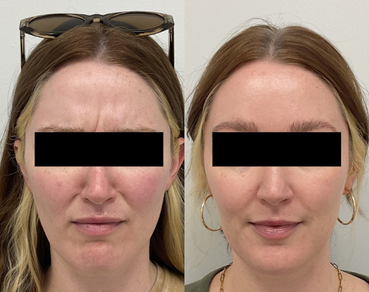 BOTOX & Dysport Before & After Gallery - Patient 356769 - Image 1