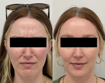 BOTOX & Dysport Before & After Gallery - Patient 356769 - Image 1