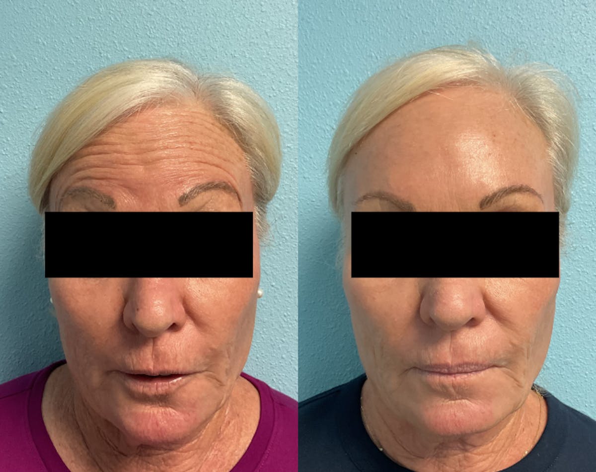 Jeuveau Before & After Gallery - Patient 372118 - Image 1
