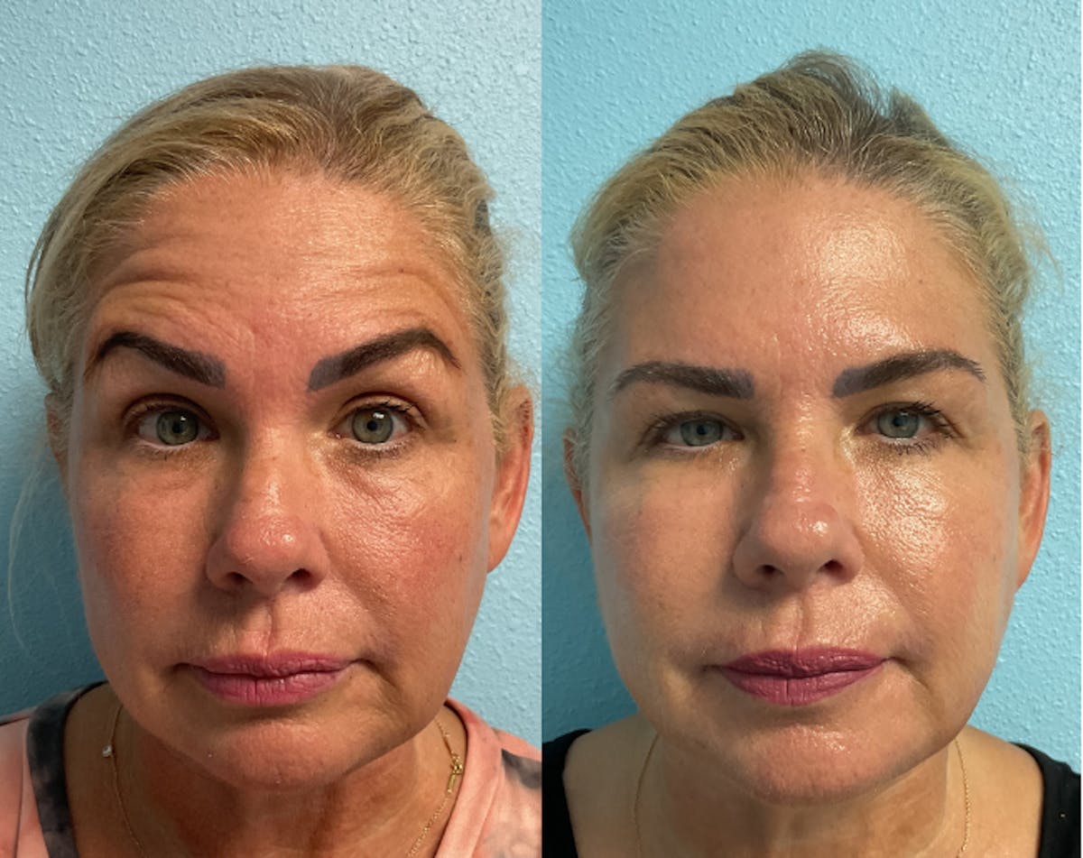 Jeuveau Before & After Gallery - Patient 221277 - Image 1