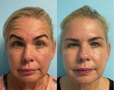 Jeuveau Before & After Gallery - Patient 221277 - Image 1