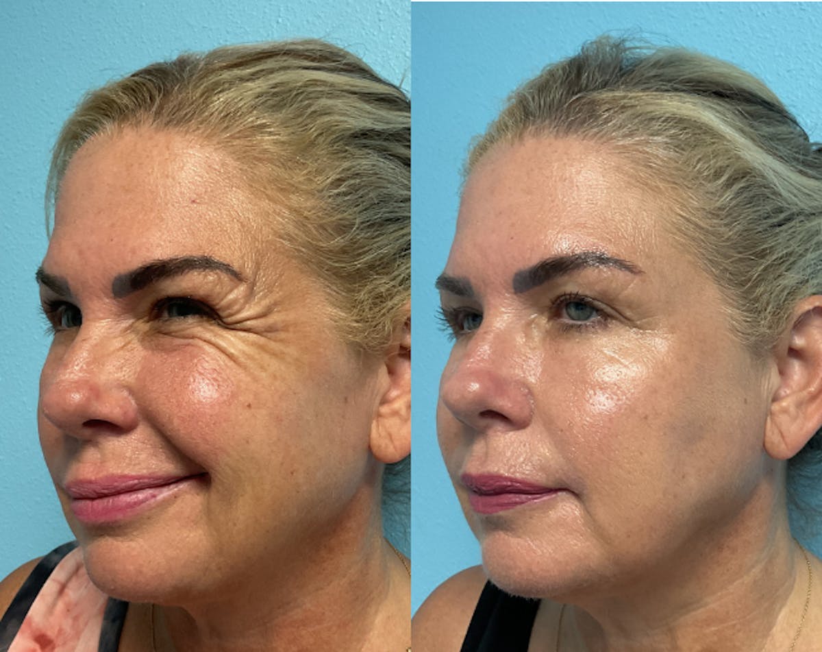 Jeuveau Before & After Gallery - Patient 221277 - Image 2