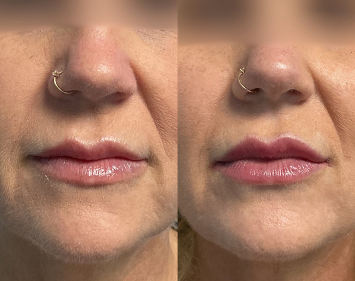 Dermal Fillers Before & After Gallery - Patient 256934 - Image 1