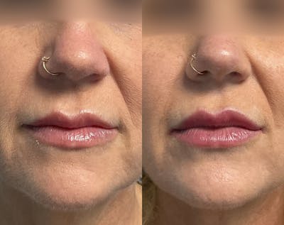 Dermal Fillers Before & After Gallery - Patient 256934 - Image 1