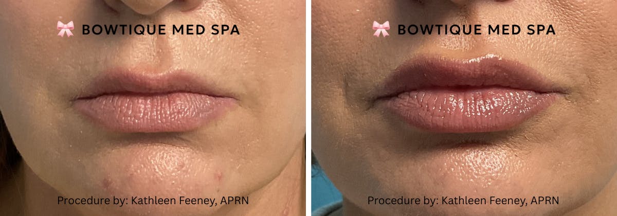 Juvederm Before & After Gallery - Patient 223709 - Image 1
