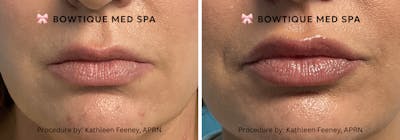 Juvederm Before & After Gallery - Patient 223709 - Image 1