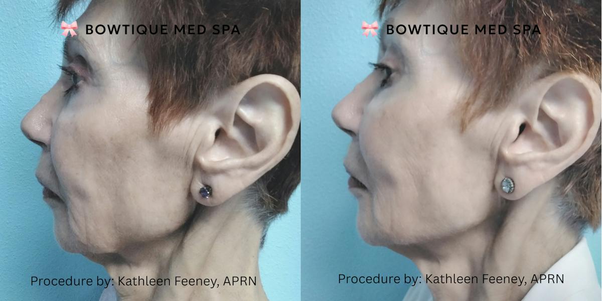 Juvederm Before & After Gallery - Patient 257967 - Image 1
