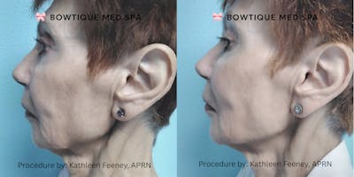 Juvederm Before & After Gallery - Patient 257967 - Image 1
