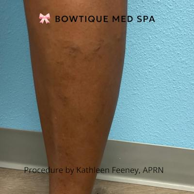 Sclerotherapy Before & After Gallery - Patient 397047 - Image 2