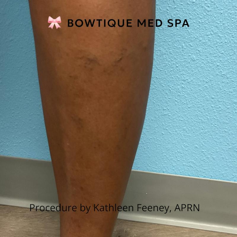 Sclerotherapy Before & After Gallery - Patient 397047 - Image 2