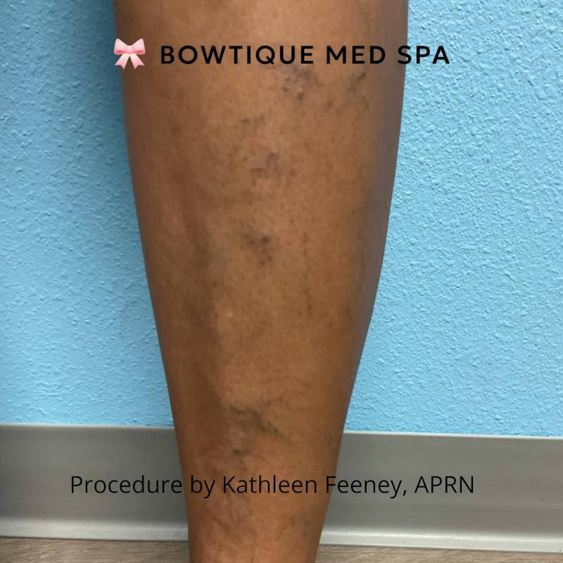 Sclerotherapy Before & After Gallery - Patient 397047 - Image 1
