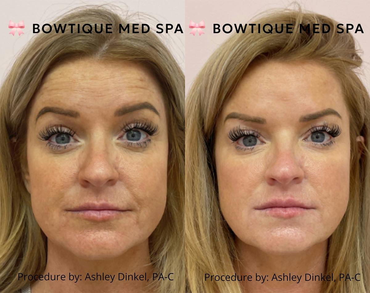 BOTOX & Dysport Before & After Gallery - Patient 374236 - Image 1