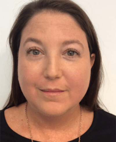 Oxygenetics Before & After Gallery - Patient 166851 - Image 2