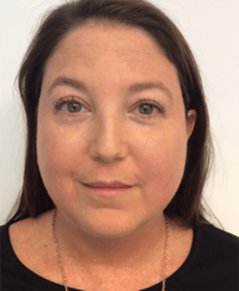 Oxygenetics Before & After Gallery - Patient 166851 - Image 2