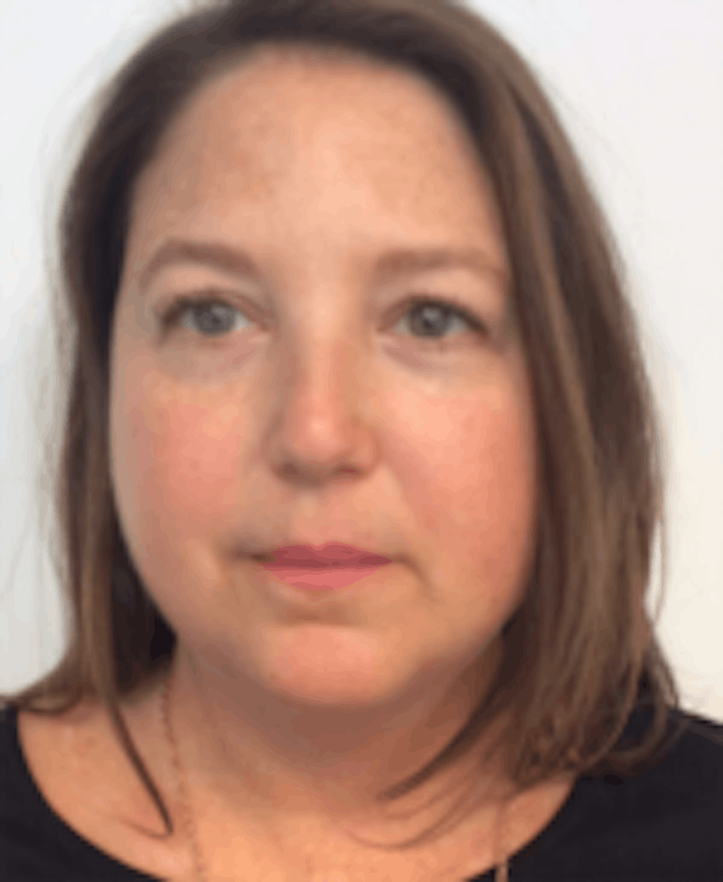 Oxygenetics Before & After Gallery - Patient 166851 - Image 3