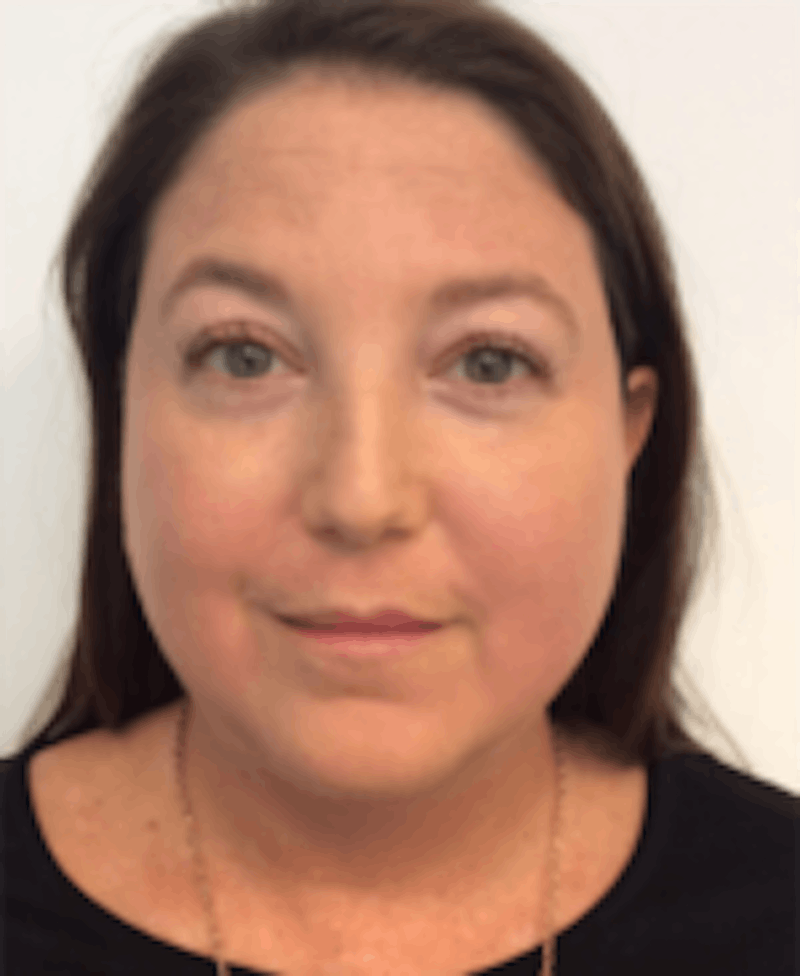 Oxygenetics Before & After Gallery - Patient 166851 - Image 4