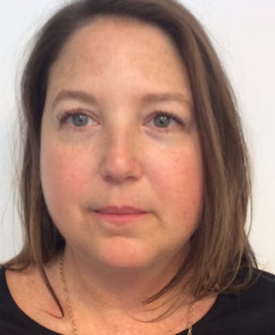 Vbeam Before & After Gallery - Patient 108352 - Image 1
