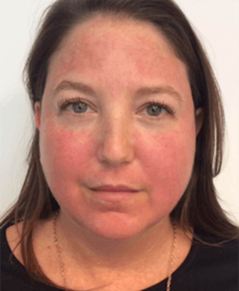 Vbeam Before & After Gallery - Patient 108352 - Image 2