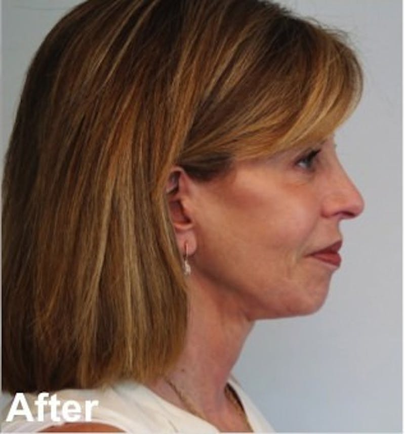 Facelift Before & After Gallery - Patient 335222 - Image 6
